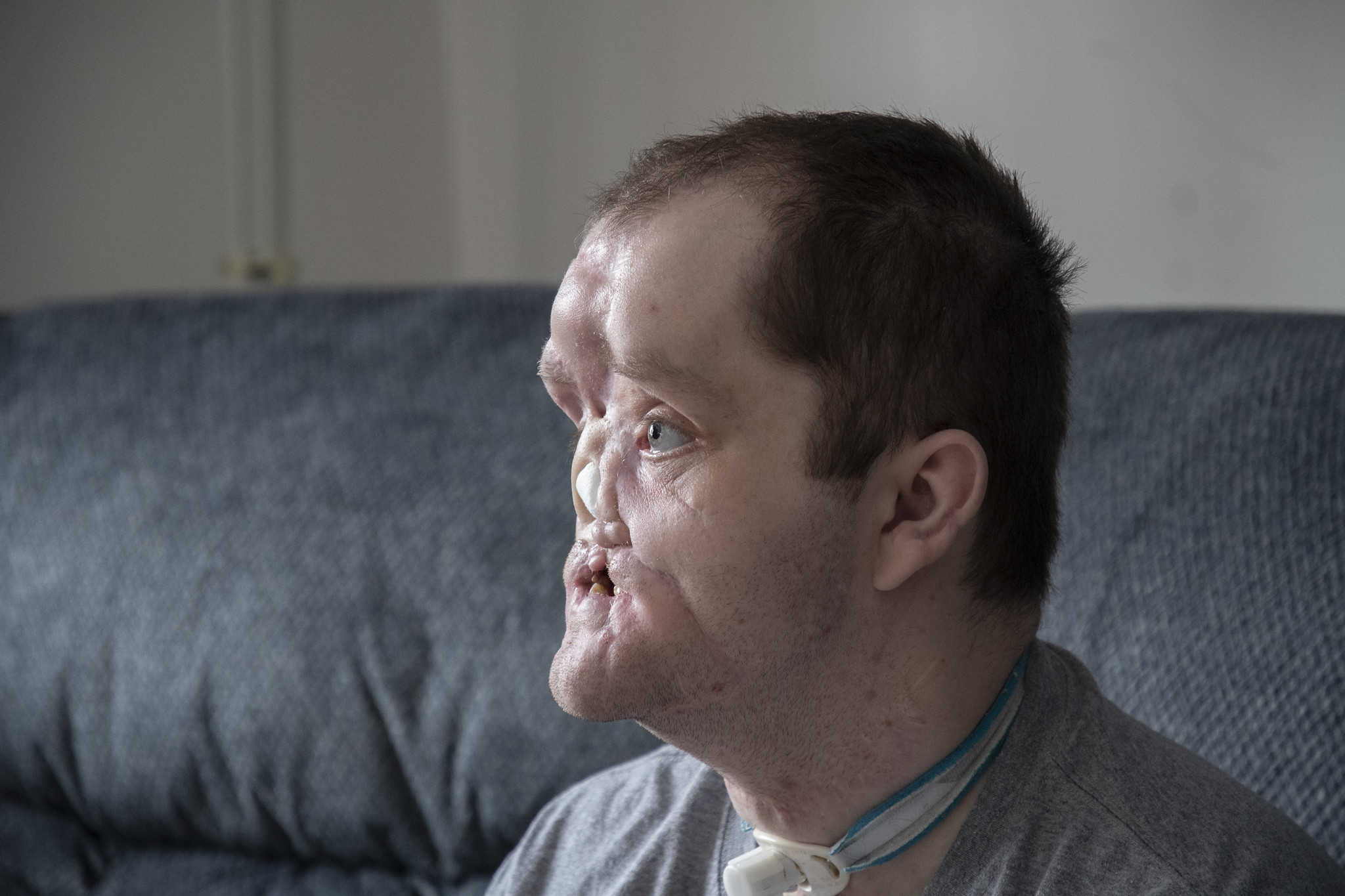 Derek Pfaff sits in his Harbor Beach home. His face has been traumatically injured.