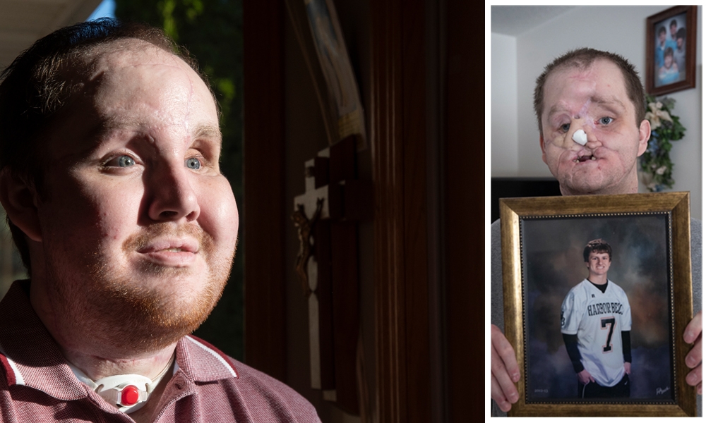 Derek Pfaff after his face transplant and a photo of his injured face as he holds his senior photo